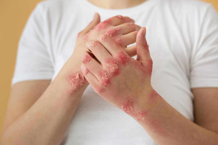 Enfrentando la psoriasis